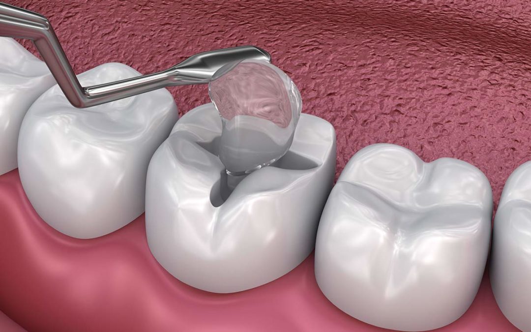 Dental Fillings Overview